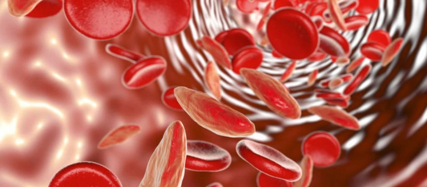 Σιδηροπενική αναιμία: Το νου σας σε αυτά τα πρώιμα συμπτώματα